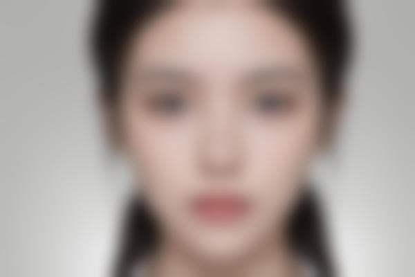 疤痕修复技术真实改变人生