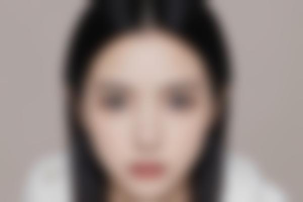 北京张云林医生年轻化微雕怎么样？自然抗衰+光电美肤，面部重塑真的绝！