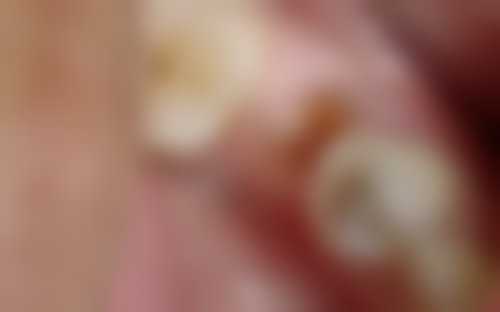 韩国奥齿泰什么材质？揭秘其优势