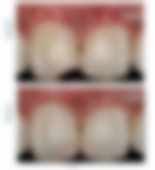 四、广州天河美云口腔瑞士义获嘉树脂美学补牙项目口碑实例