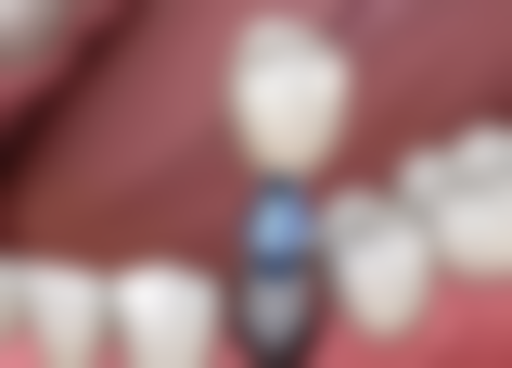 不同国内种植牙对比，哪个国内的种植牙价格合理又适合保留牙根种植？