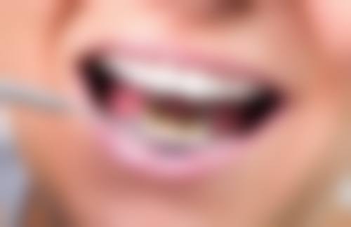 拔牙后种植牙的价格区间及费用差异来源