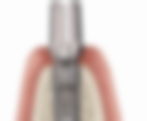 拔牙后种植牙时机的常见认知偏差与误解