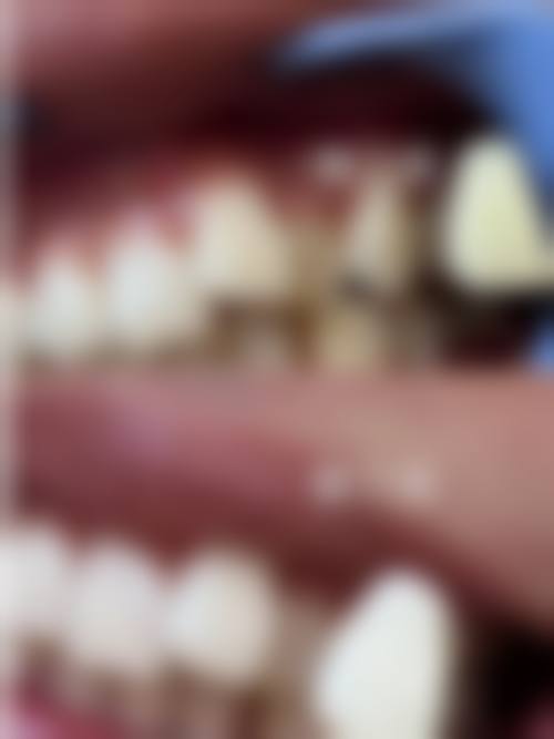 在决定是否选择39岁牙齿矫正前,普通用户更容易忽略的关键评估点