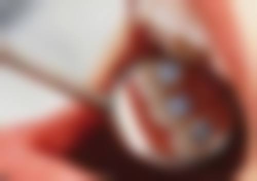 牙周炎根管治疗多少钱