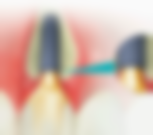 韩国登腾与美国皓圣种植牙价格区间及费用差异来源