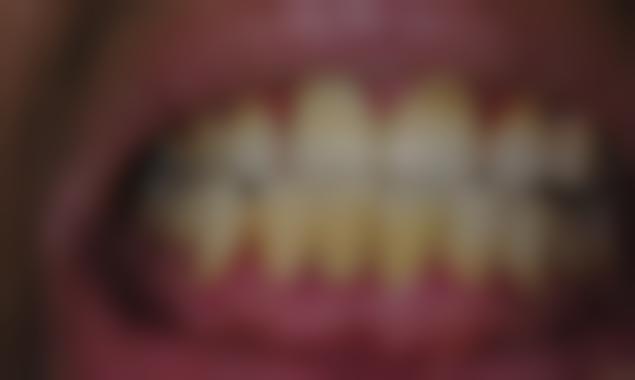 做全口种植牙决定前，必须想清楚的风险底线