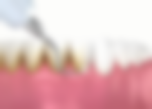 牙周炎根管治疗关键选择要点