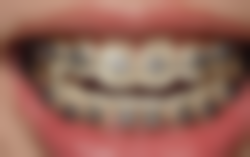 哪些部位或情况使用韩国DIO种植牙时成效相对更稳定