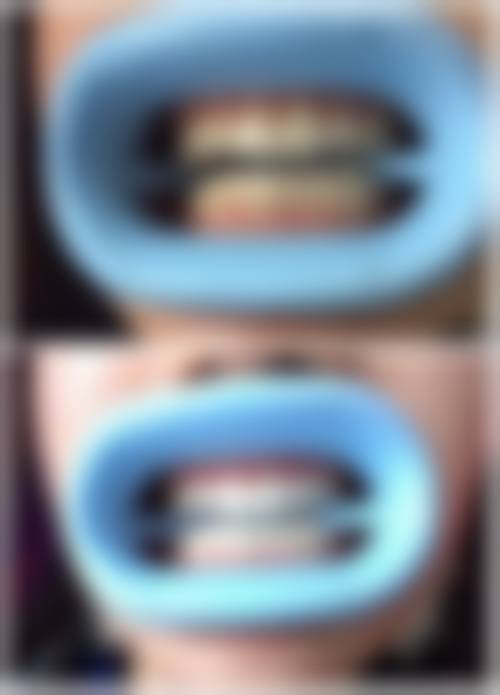 牙齿矫正器怎么打开？3种实用技巧轻松解锁活动/隐形/自锁托槽正确打开姿势！