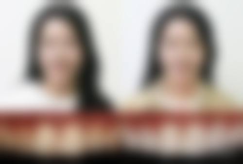 缺牙修复全程直击——时间安排与操作步骤深度解析