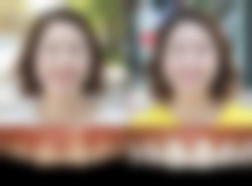 烤瓷牙哪些人群适合，哪些情况不建议选择？