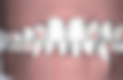 全口缺失种植牙的医院医生选择攻略