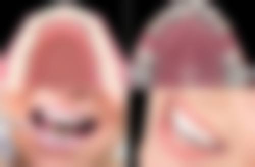 18岁矫正牙齿晚不晚？当然不晚！骨骼可塑性好，8000元起效果佳