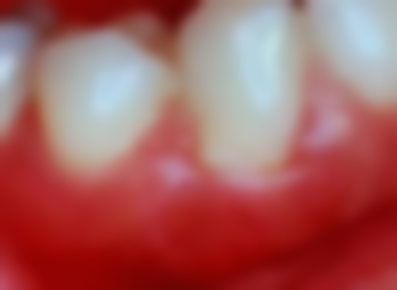 国产种植牙的价格区间及费用差异来源