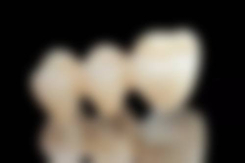 全口种植牙是什么？在什么情况下会被选择？