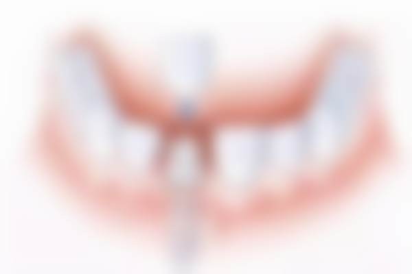 1、数字化精细种植牙