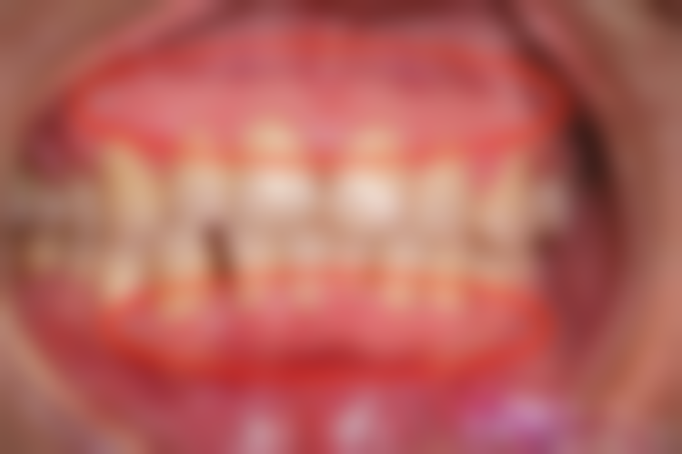 全口种植牙手术或治疗成效能维持多久？