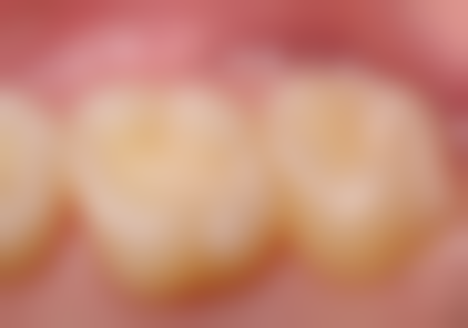 全口种植牙技术或材料本身的优势与局限