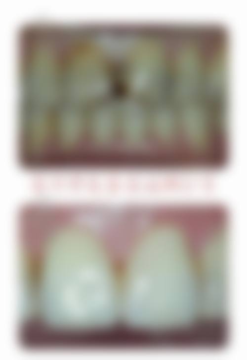 在决定是否选择矫正牙齿拔牙前，普通用户更容易忽略的关键评估点及医院医生推荐名单