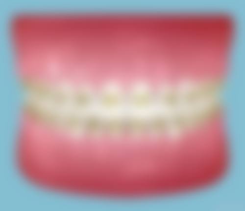 矫正牙齿拔牙4颗有危害吗？