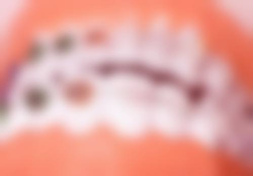 香港 珠海拱北牙科社保定点 術前術後避坑指南