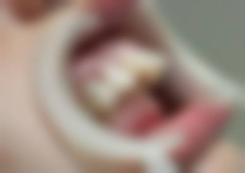 香港 種植牙橋 適合邊類人群?3大優勢話你知