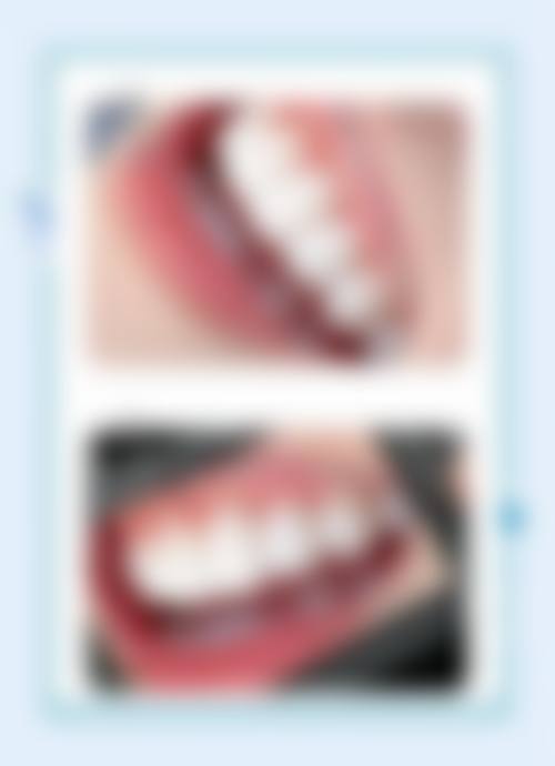 澳门牙科热门项目实测:洗牙/阻生牙拔除/箍牙边间更掂?