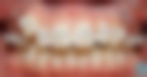 二十多岁正畸牙齿,成效看得见!