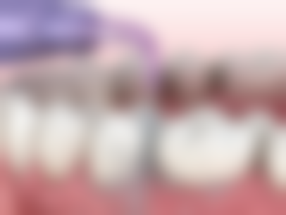 上海全口种植牙齿价格的影响因素及怎么选择