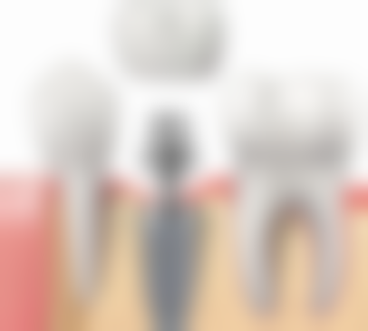 1. 種植牙橋究竟係咩?同傳統牙橋有咩分別?