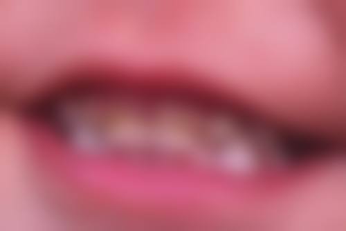 香港 種植牙收費 診所揀選要點：3步避開黑診所！