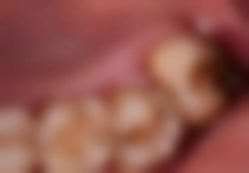 美国种植牙医院与医生选择中,哪些因素更关键?及医院医生推荐!