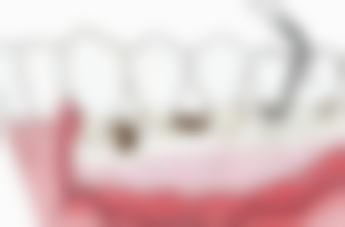 美国种植牙哪些人群适合,哪些情况不建议选择?