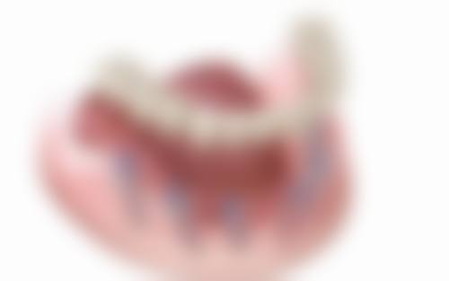 allon4植牙費用香港2026最新｜市場價參考！幾錢一隻？一文睇清收費