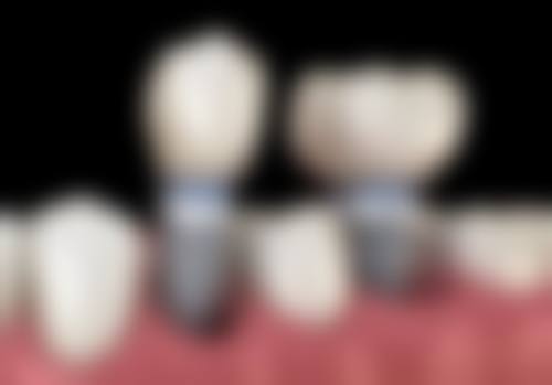 理性提醒:香港植牙一定要揀合规診所!