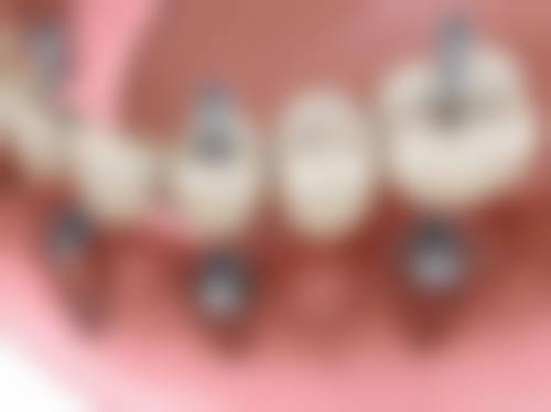 香港 大陸植牙一顆多少錢? 國產vs進口差幾多?