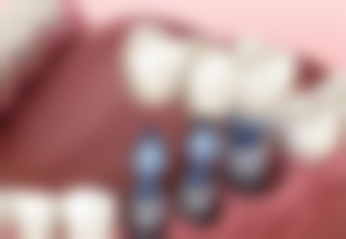 香港All-on-4植牙收費隱藏陷阱:呢3樣嘢一定要問清楚