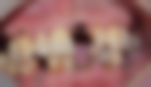 All-on-4植牙常見Q&A:香港姊妹更關心嘅5個問題