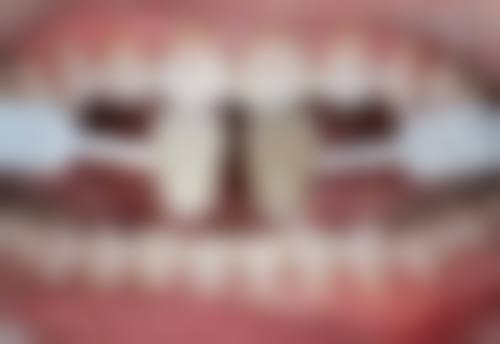 深圳口岸種牙攻略：香港人過關種牙點樣更抵？