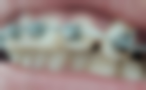 香港 香港大學深圳醫院牙科好唔好 價錢範圍（HKD）大公開