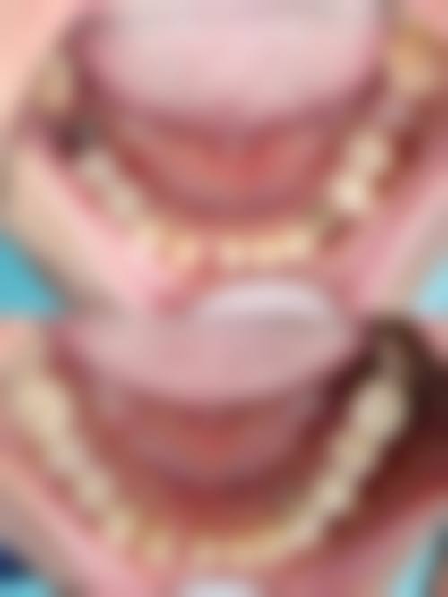 拓展延伸:植牙項目真相 + 關鍵選擇點 + 避坑指南