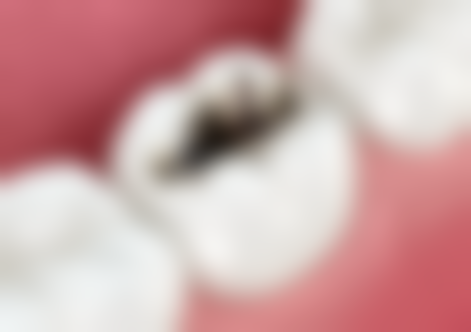 種植牙項目真相：香港人更關心嘅3個問題