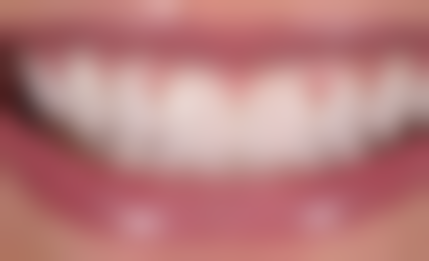 香港 種植牙收費 項目細解：邊啲錢該花？邊啲可以慳？