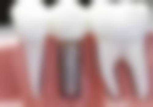 理性提醒：香港微創植牙，安心永遠排第一