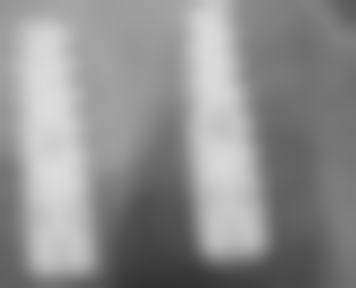 拓展延伸：微創植牙香港 你仲要知嘅3件事