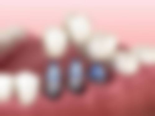 拓展延伸：種牙/正畸真相+避坑指南