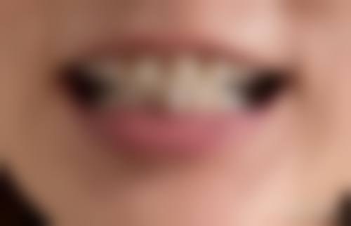 43 岁矫正牙齿纠结得特别到底怎么办好