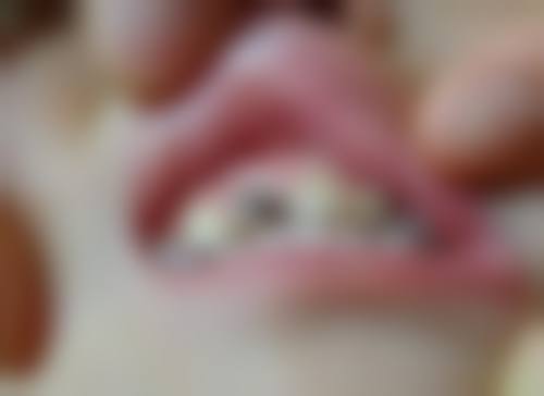 拓展延伸：蛀牙就診3大真相+避坑指南