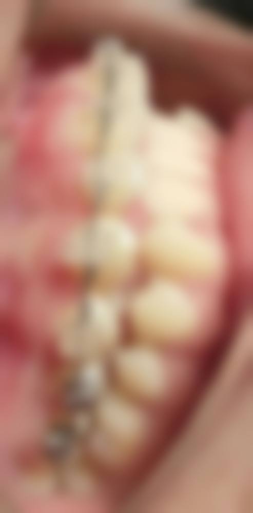 十八岁矫正地包天需要多久